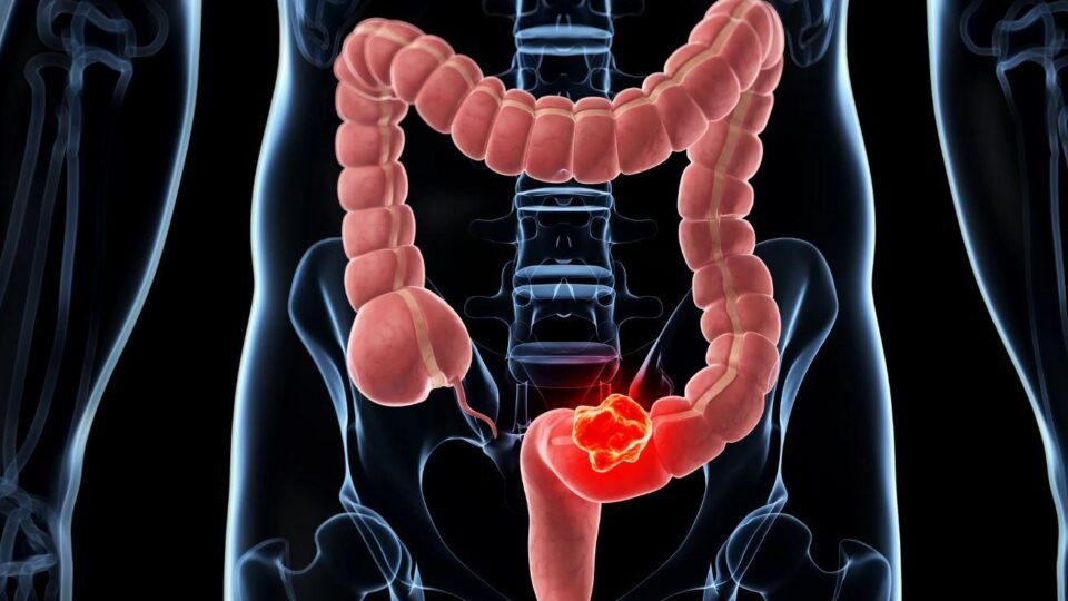 دراسة: أدوية الكوليسترول تقلل خطر الإصابة بسرطان القولون
