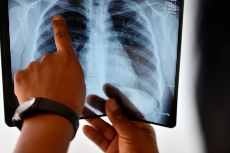 حوالي 34% من حالات الإصابة بالسل في ناميبيا غير مشخصة